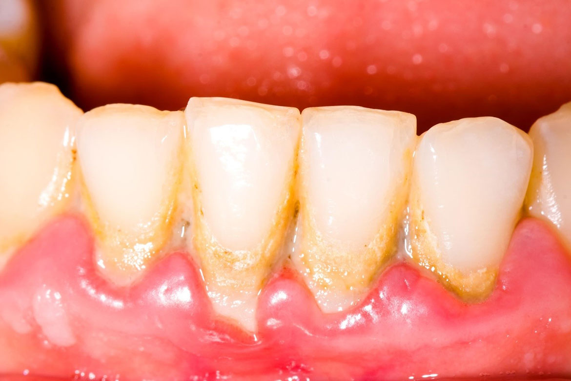 Cao răng chứa rất nhiều vi khuẩn