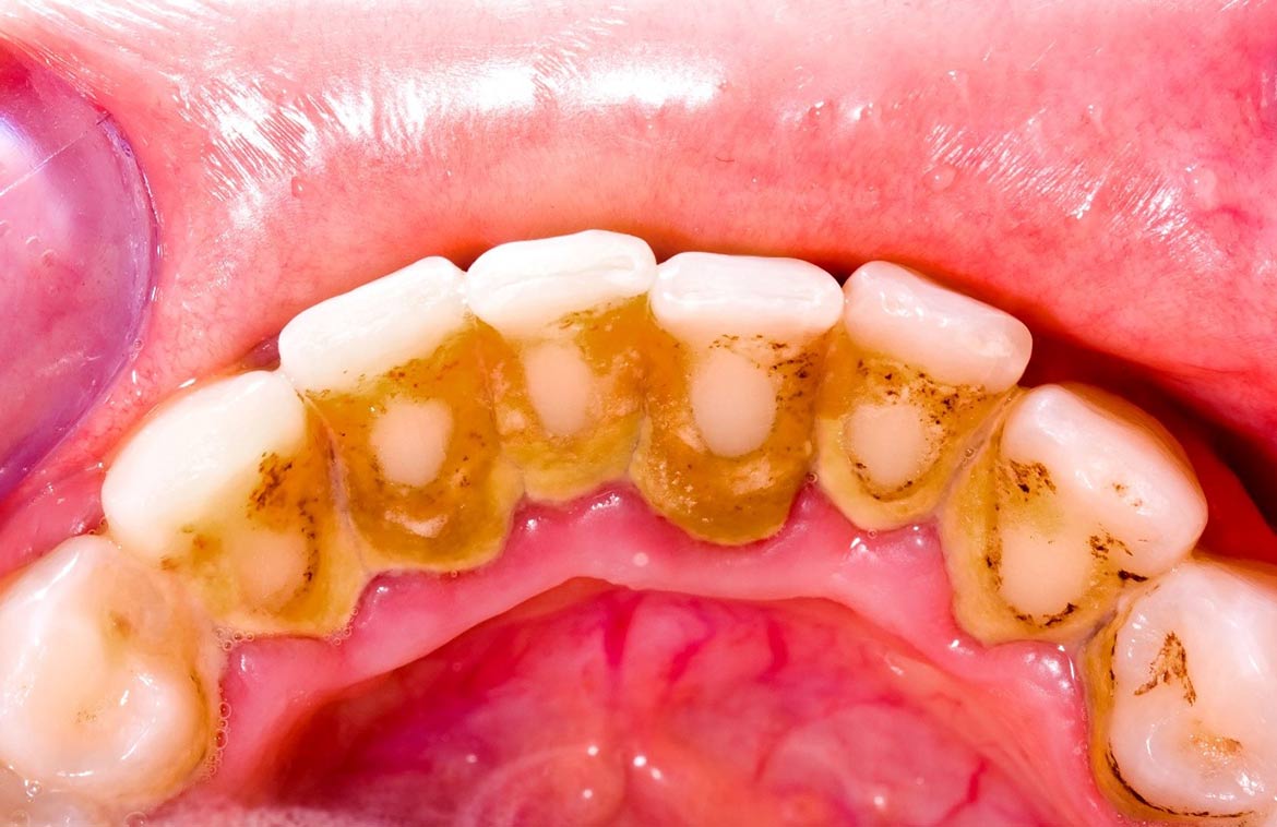 Cao răng là một trong những nguyên nhân chính gây viêm lợi
