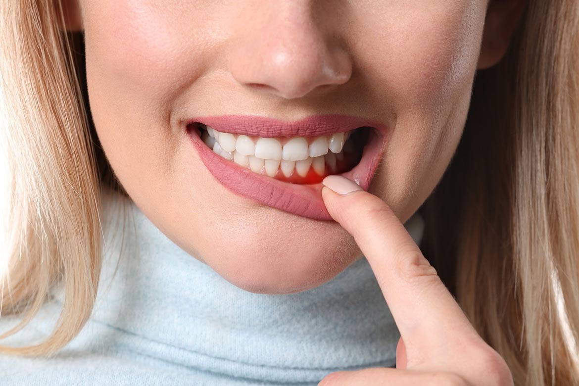 Điều trị bệnh viêm lợi, lợi chảy máu