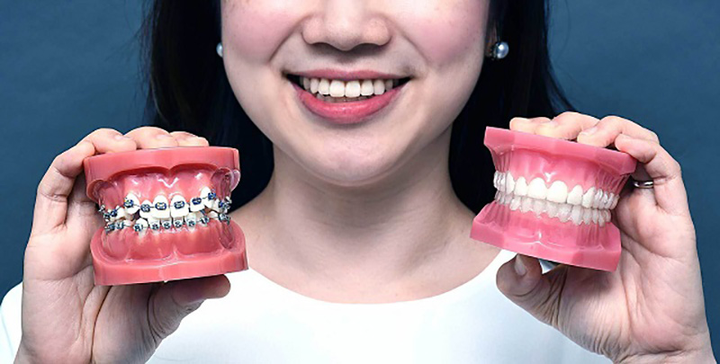 Niềng răng l&agrave; g&igrave;