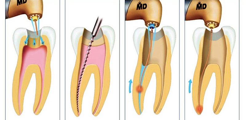 Quy tr&igrave;nh điều trị tủy răng gồm 4 bước