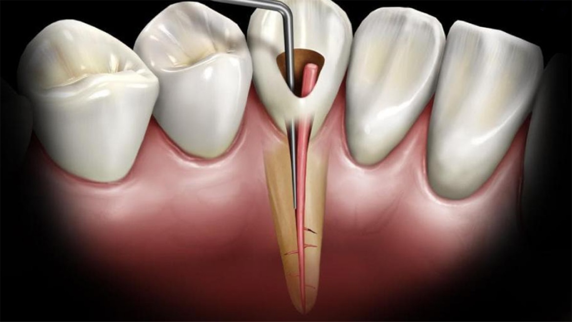5 bước điều trị viêm tủy răng