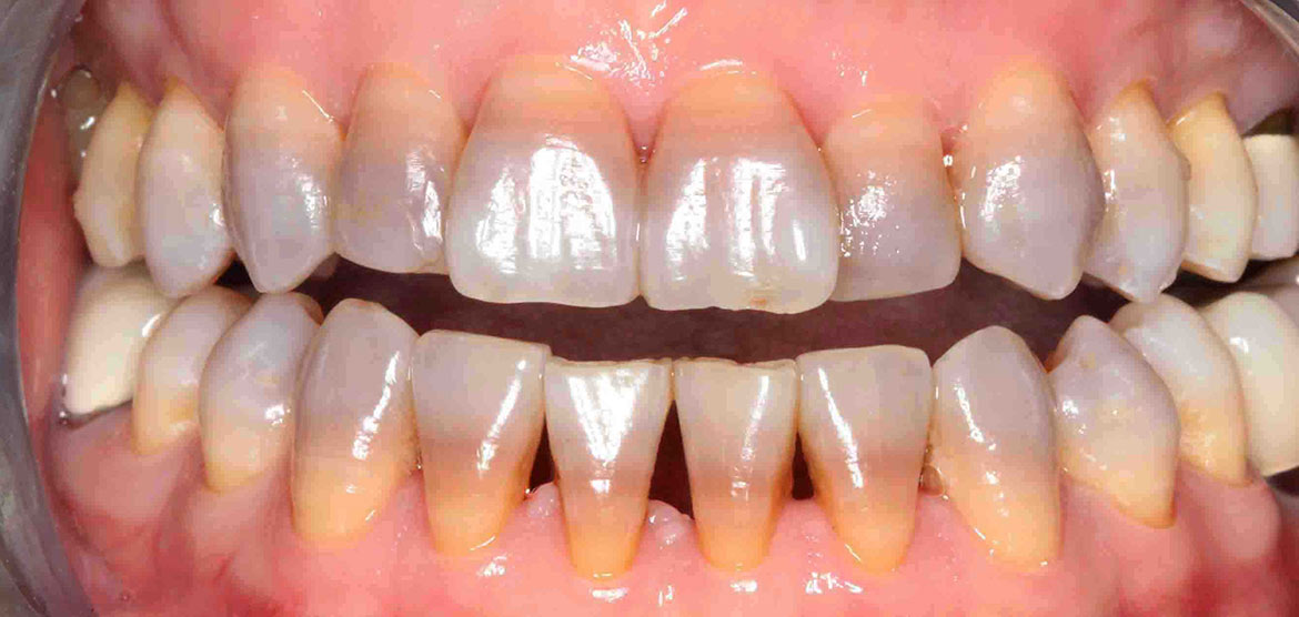 Răng bị ố màu do nhiễm kháng sinh hoặc hút thuốc