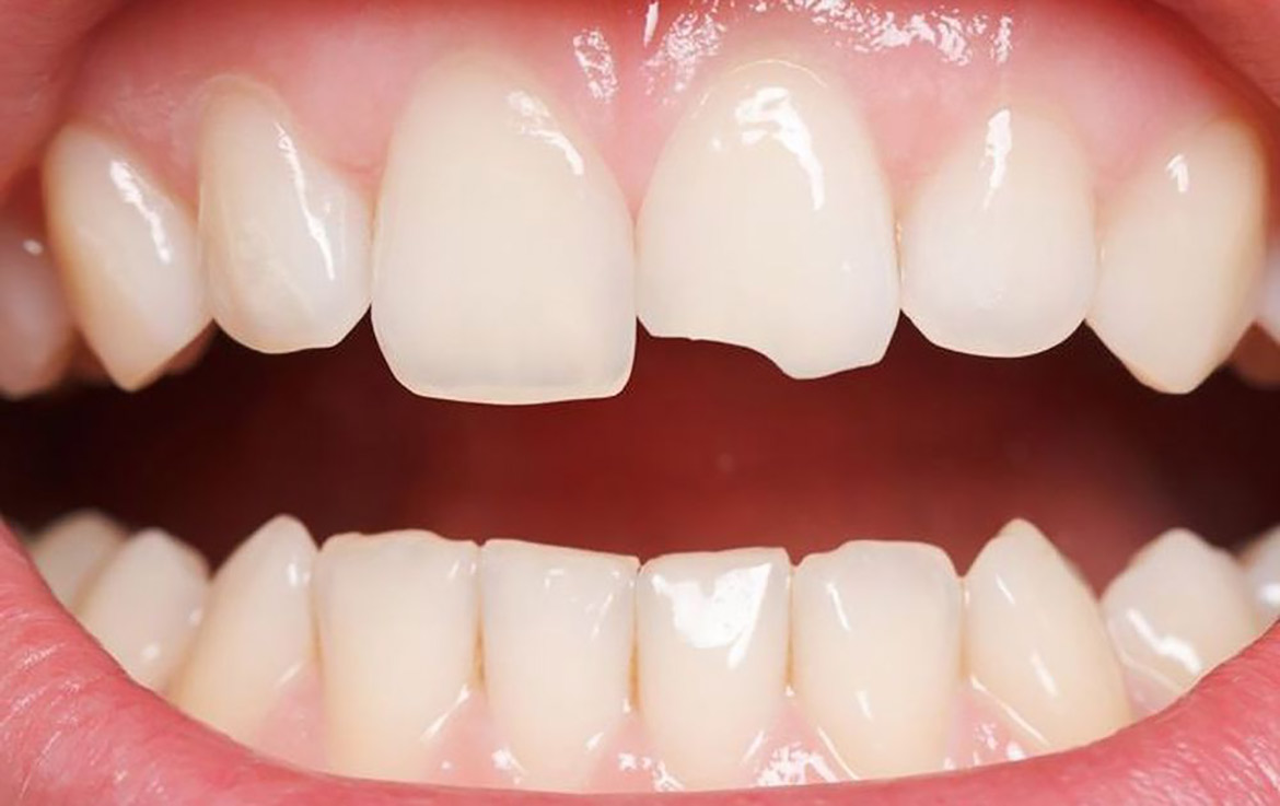 Răng bị sứt mẻ, cần xử lý trám răng thẩm mỹ