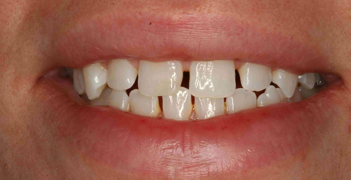 Răng thưa gây mất thẩm mỹ và sức khỏe răng miệng