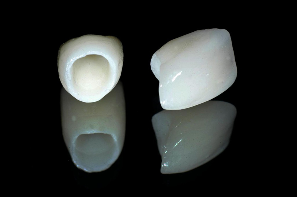 Bọc răng sứ là gì