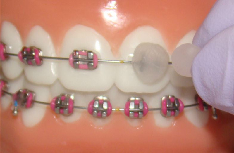 Wax Orthodontic