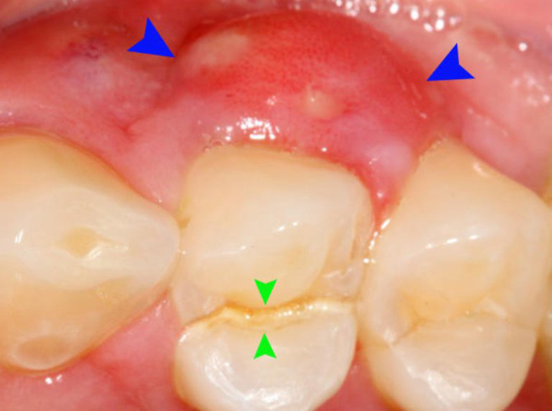 Vi&ecirc;m tủy răng g&acirc;y n&ecirc;n sưng nướu