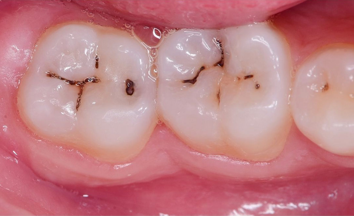 Răng bị sâu nên tiến hành trám răng thâm mỹ
