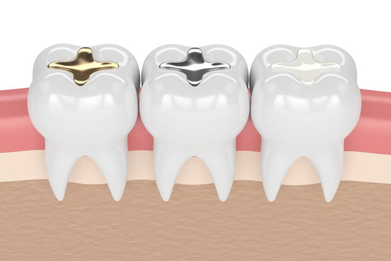 C&oacute; nhiều loại vật liệu tr&aacute;m răng kh&aacute;c nhau