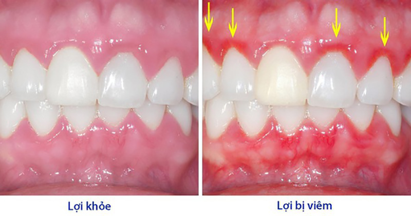 Dấu hiệu nhận biết bệnh vi&ecirc;m lợi