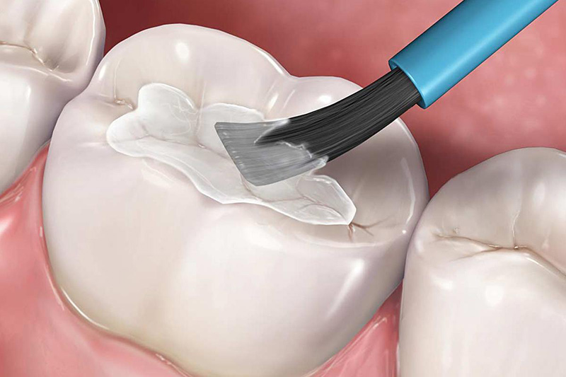 Giới thiệu về tr&aacute;m răng thẩm mỹ