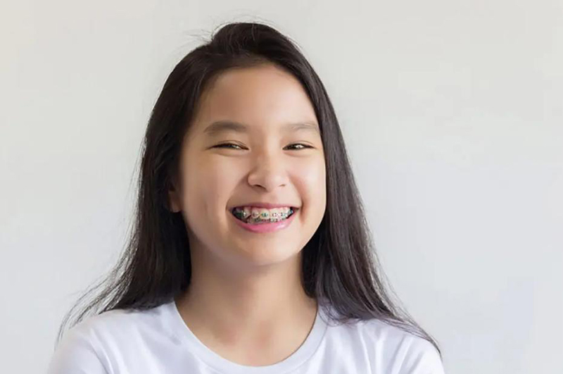 Độ tuổi niềng răng tốt nhất l&agrave; ở độ tuổi thanh thiếu ni&ecirc;n