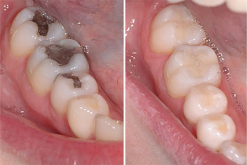 Tr&aacute;m răng thẩm mỹ c&oacute; thể k&eacute;o d&agrave;i được từ 10-15 năm nếu được chăm s&oacute;c đ&uacute;ng c&aacute;ch