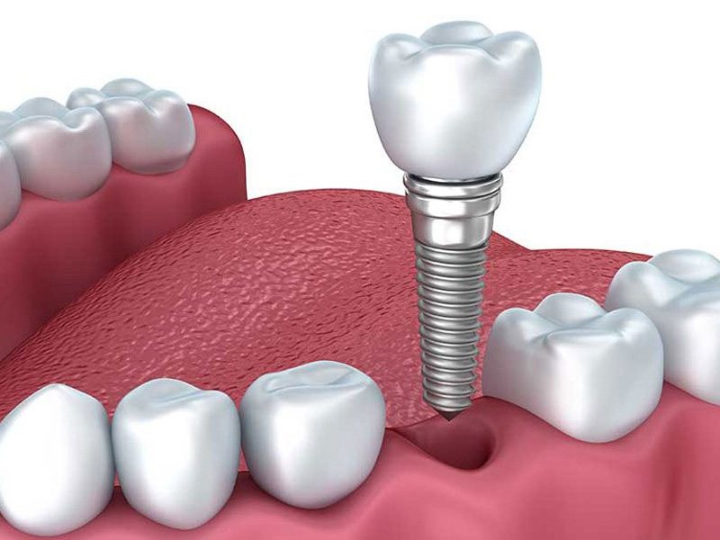 Trồng răng implant l&agrave; g&igrave;, quy tr&igrave;nh thế n&agrave;o