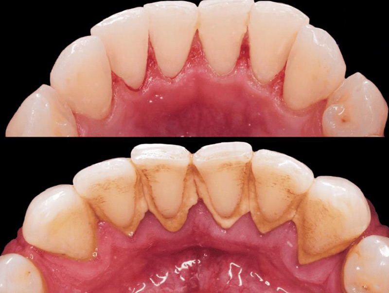 Trước v&agrave; sau khi lấy cao răng