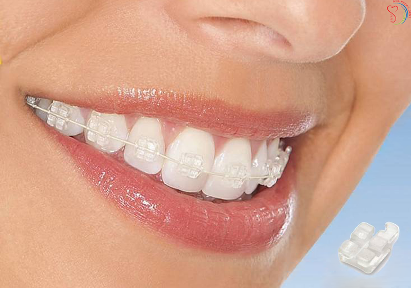 Niềng răng có được vĩnh viễn không? Giải đáp thắc mắc cho bạn 3 20190930 050109 144815 nieng rang tham my