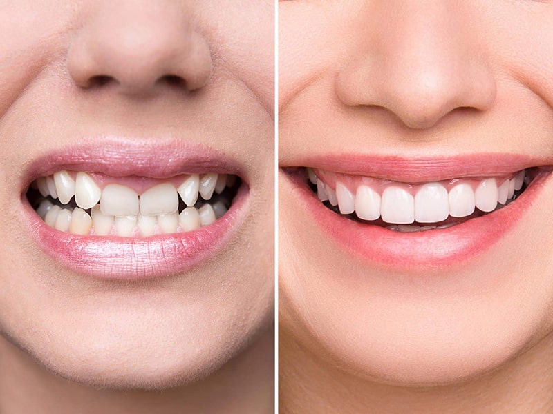 Quy trình bọc răng sứ diễn ra như thế nào ? 1 Quy trinh boc rang su cho rang sau 8