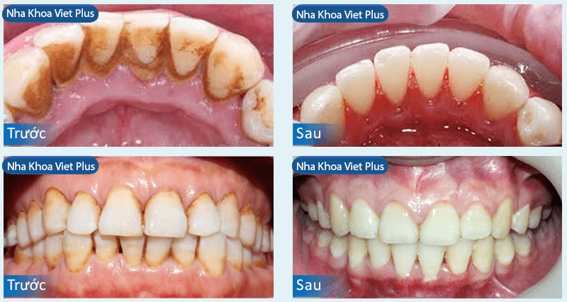 lấy cao răng tại Thanh Ho&aacute; 