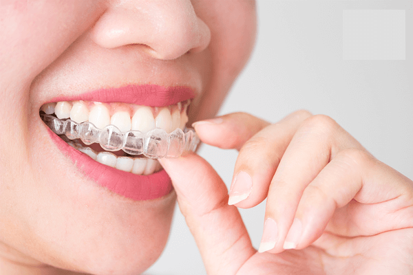 Niềng răng có được vĩnh viễn không? Giải đáp thắc mắc cho bạn 4 nieng rang trong suot A4 1 1