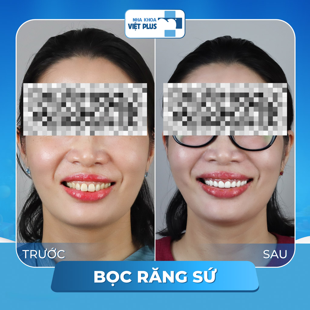 bọc răng sứ cho răng h&ocirc; vẩu