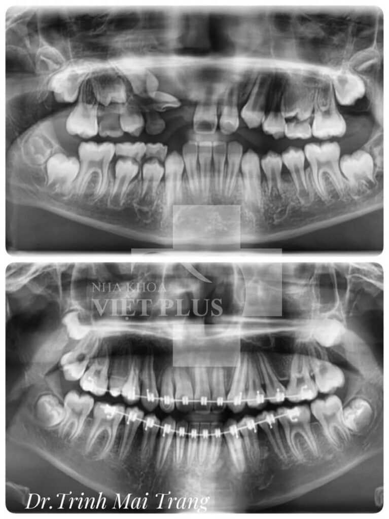 Quy trình trồng răng implant tại Thanh Hoá 3 294012629 419223163557531 448498665920006703 n