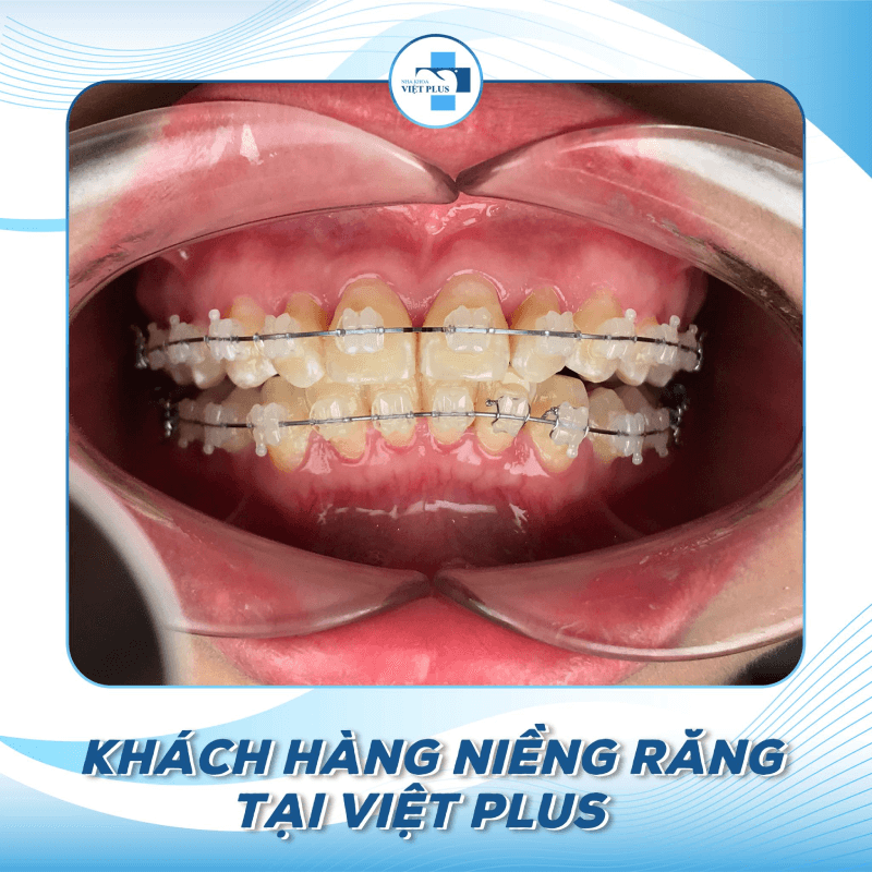 Niềng răng mắc cài kim loại là gì ? Chi phí niềng răng bao nhiêu ? 2 316058161 514718710674642 6287397064133754884 n 1
