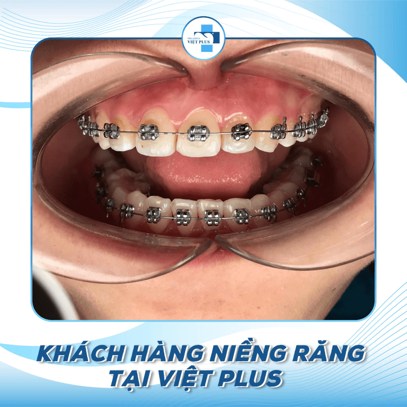 Niềng răng mắc cài kim loại là gì ? Chi phí niềng răng bao nhiêu ? 1 316196576 514718690674644 8188379949222038320 n 1