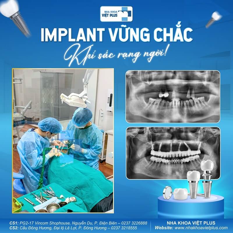 Quy trình trồng răng implant tại Thanh Hoá 4 441621654 879731034173406 571746054322247699 n 1