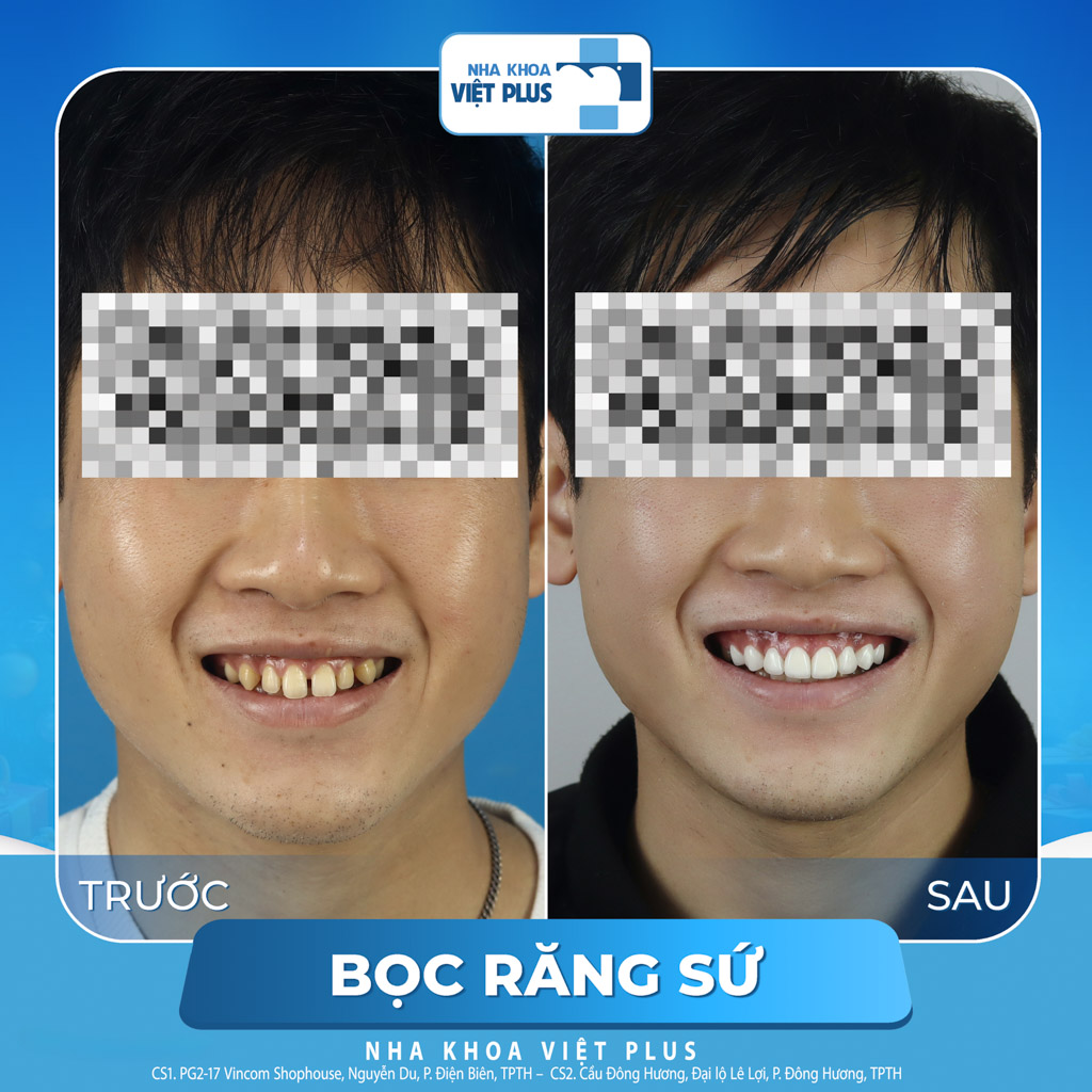 Nên dán sứ veneer hay bọc răng sứ thẩm mỹ ? 10 dán sứ veneer hay bọc răng sứ