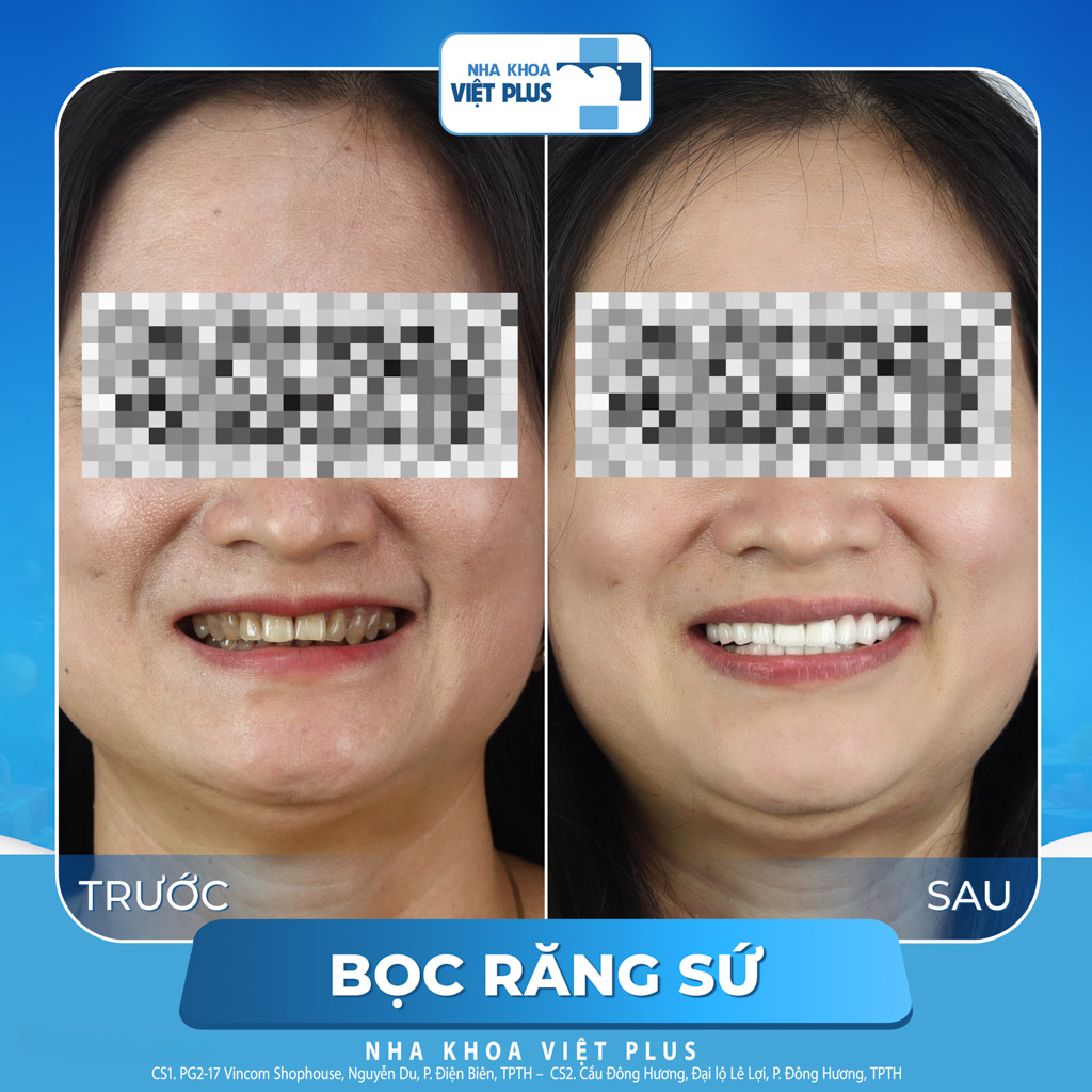 Nên dán sứ veneer hay bọc răng sứ thẩm mỹ ? 9 dán sứ veneer hay bọc răng sứ