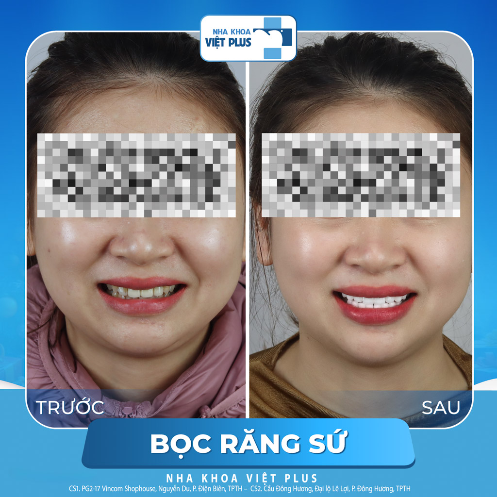 Nên dán sứ veneer hay bọc răng sứ thẩm mỹ ? 8 dán sứ veneer hay bọc răng sứ