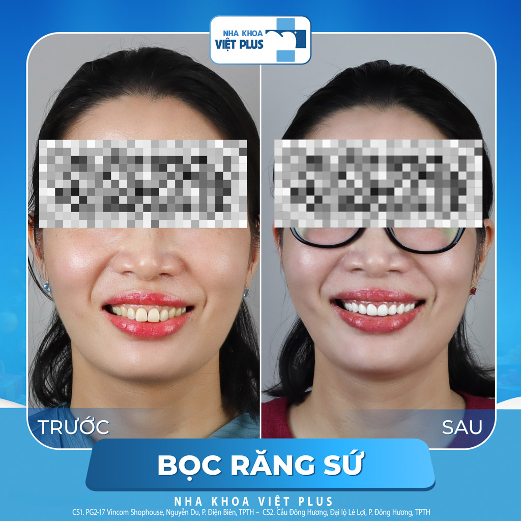 Bọc răng sứ bị thâm lợi - Nguyên nhân và cách xử lý hiệu quả 7 bọc răng sứ bị thâm lợi