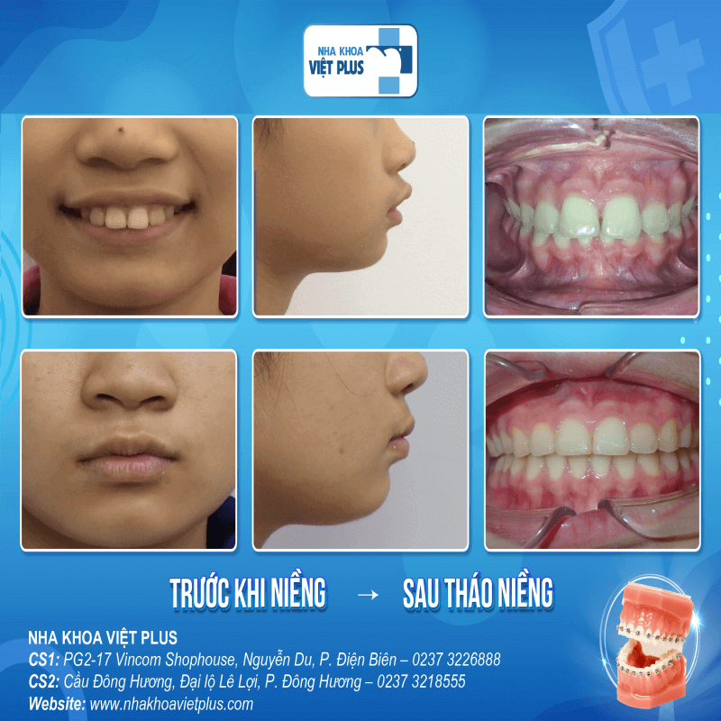 Các giai đoạn niềng răng hô chuẩn Y khoa 7 LHT 1 1 1