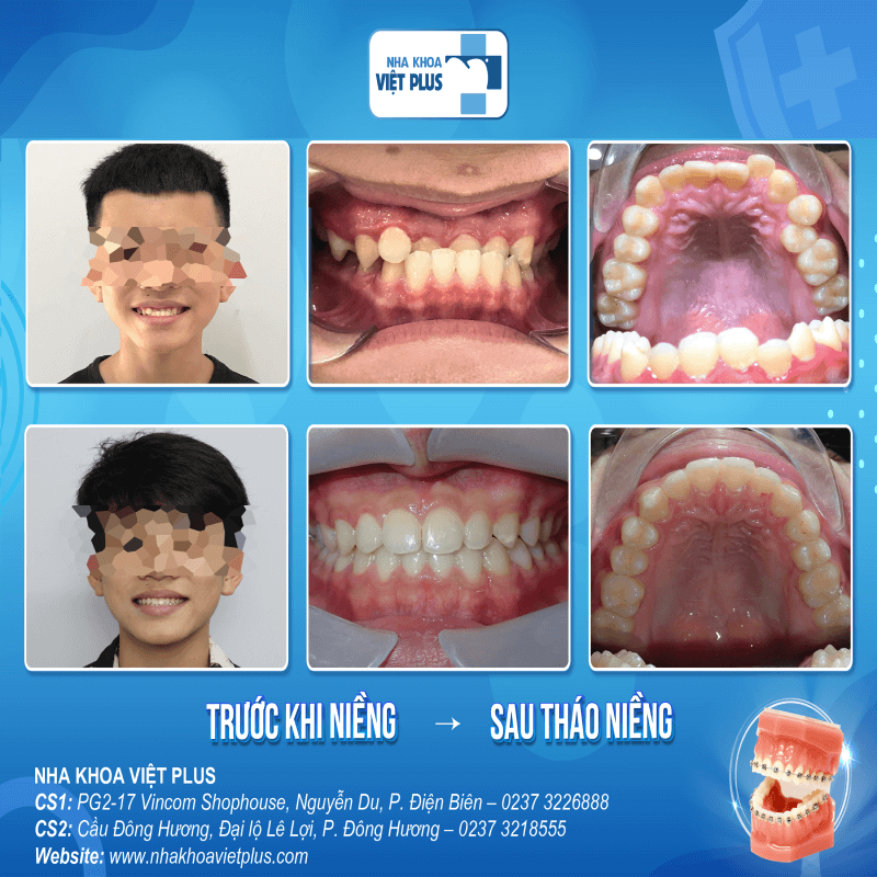 Niềng răng mắc cài kim loại là gì ? Chi phí niềng răng bao nhiêu ? 6 NCQ 1