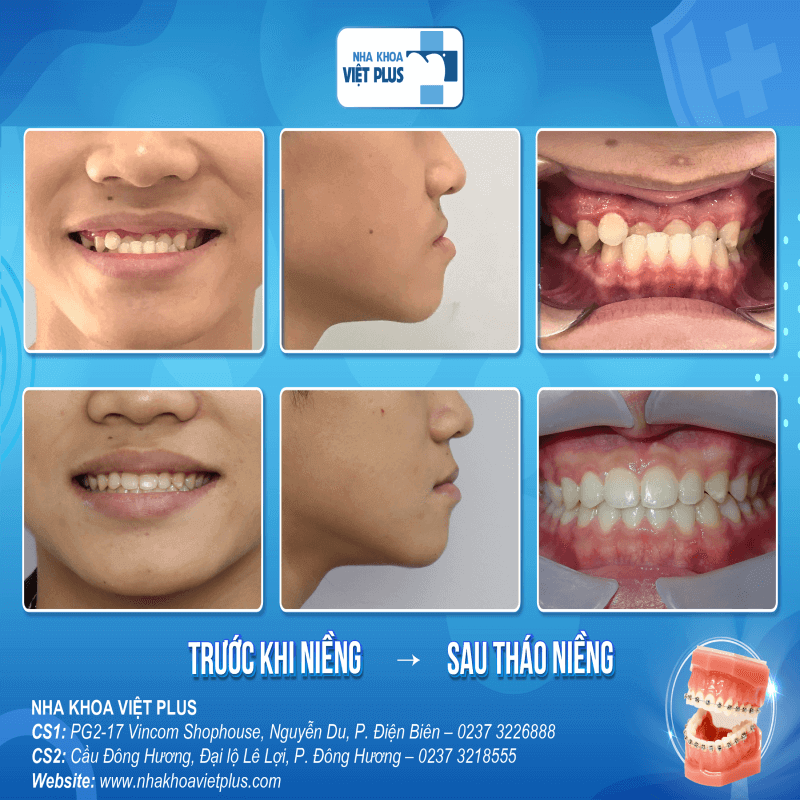 Các giai đoạn niềng răng hô chuẩn Y khoa 6 NCQ Version 2 1 1 1