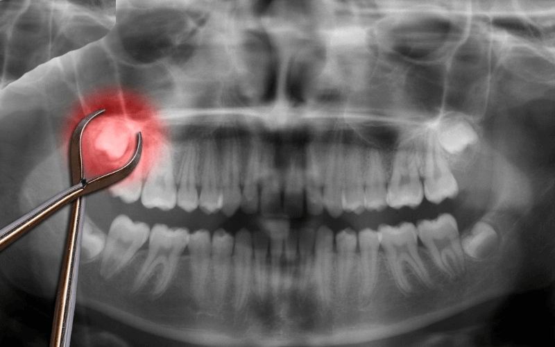 Nhổ răng khôn mọc lệch như thế nào ? Quy trình và chi phí 1 Nho rang khon ham tren 2 1