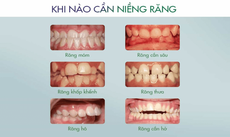 niềng răng trẻ em 