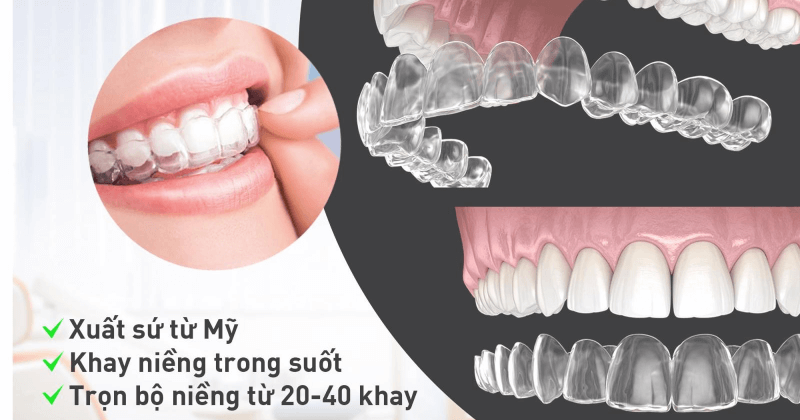 niềng răng trong suốt hay mắc c&agrave;i