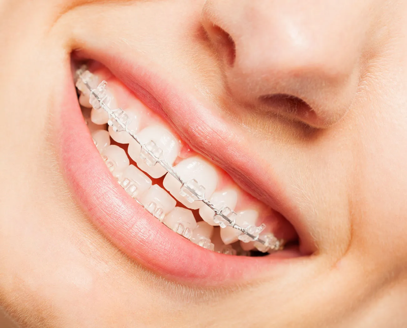 niềng răng trẻ em 
