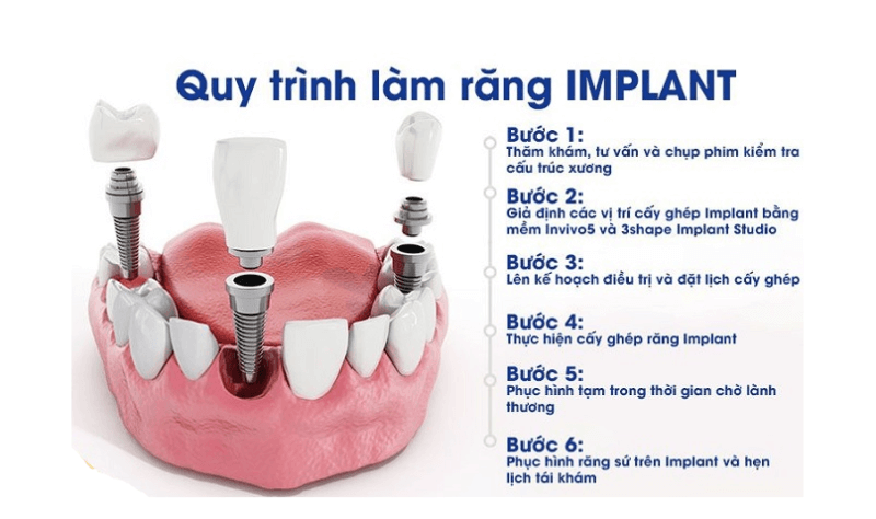 Quy trình trồng răng implant tại Thanh Hoá 1 quy trinh trong rang Implant mang lai hieu qua the nao 1 1