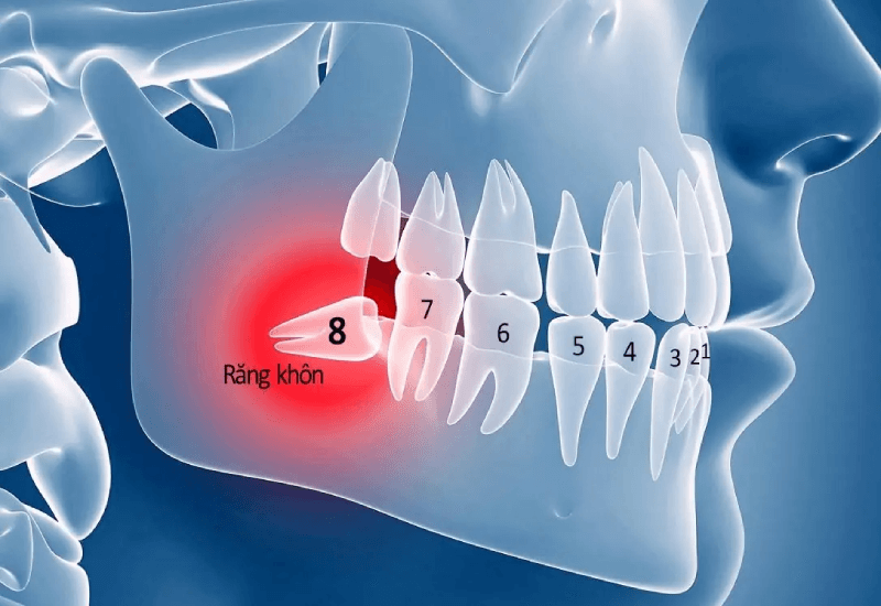 c&oacute; n&ecirc;n nhổ răng kh&ocirc;n kh&ocirc;ng