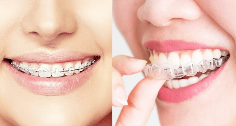 niềng răng trong suốt hay mắc c&agrave;i