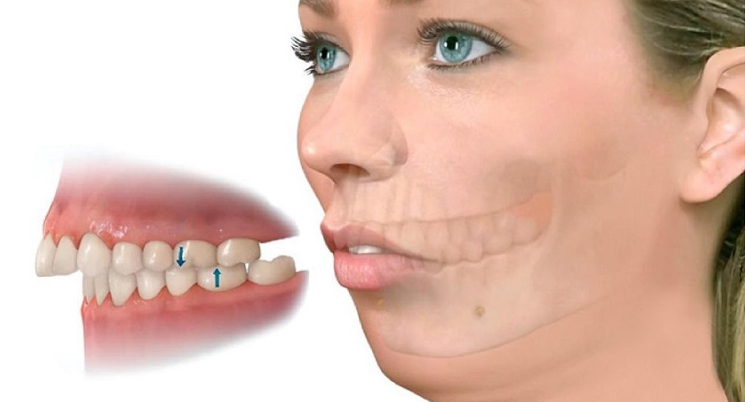 Các giai đoạn niềng răng hô chuẩn Y khoa 1 20230131 rang ho 2