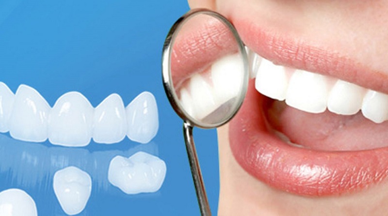 Nên dán sứ veneer hay bọc răng sứ thẩm mỹ ? 5 dán sứ veneer hay bọc răng sứ