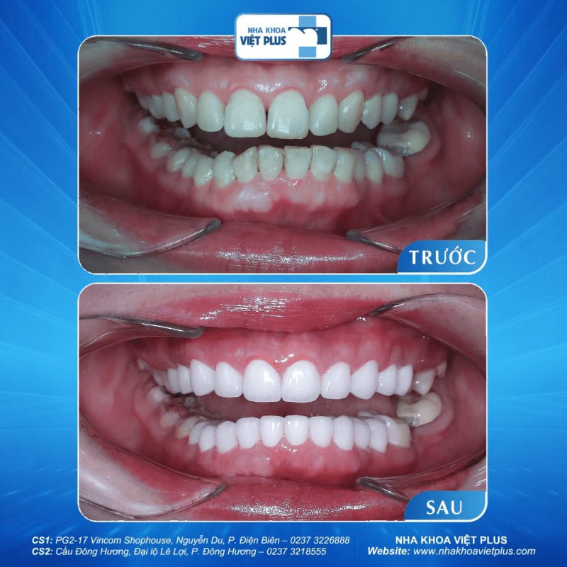 Nên dán sứ veneer hay bọc răng sứ thẩm mỹ ? 4 dán sứ veneer hay bọc răng sứ