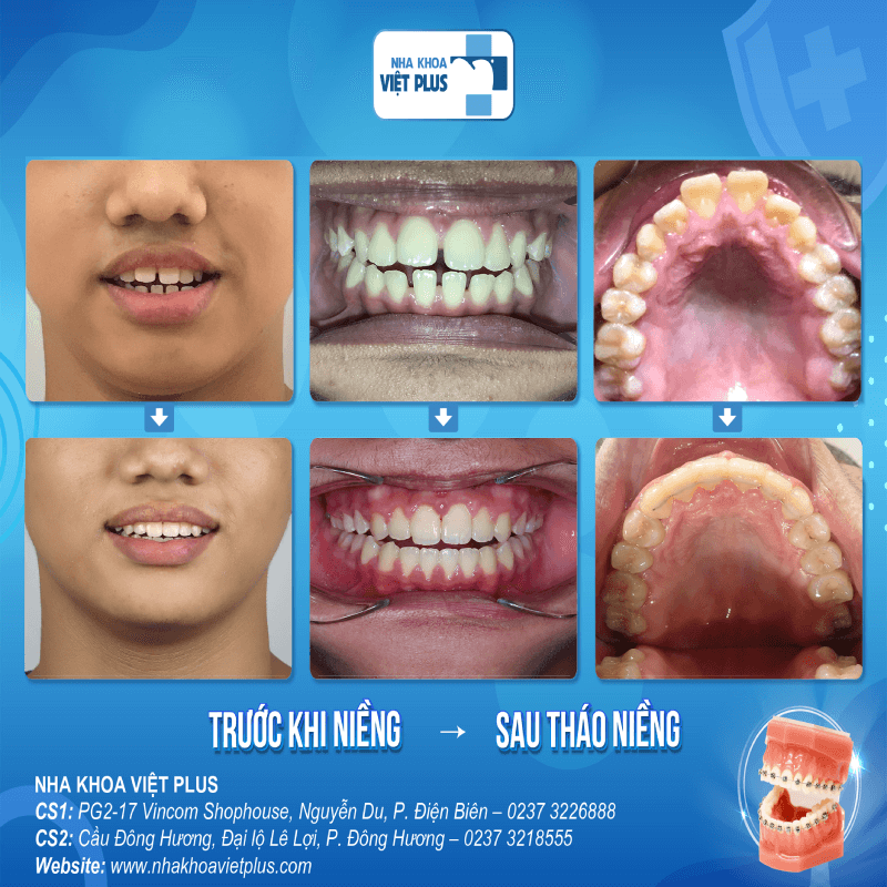 Các giai đoạn niềng răng hô chuẩn Y khoa 9 DDP 6 anh