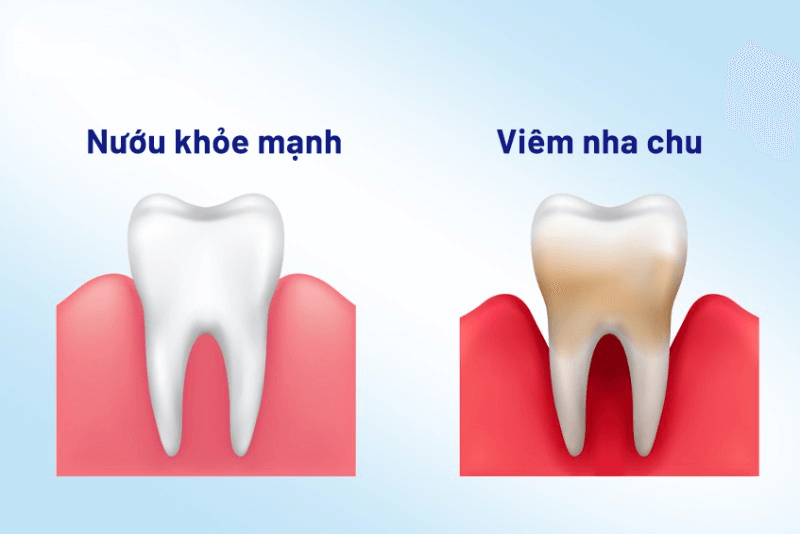 Nguyên nhân, dấu hiệu và cách điều trị viêm nha chu hiệu quả 1 benh nha chu 1