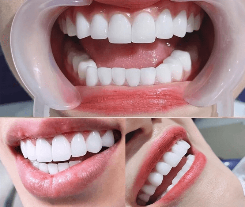 Nên dán sứ veneer hay bọc răng sứ thẩm mỹ ? 2 dán sứ veneer hay bọc răng sứ