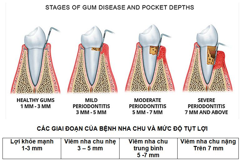 Nguyên nhân, dấu hiệu và cách điều trị viêm nha chu hiệu quả 5 nha chu1